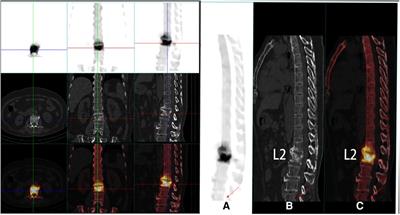 Continuous cement leakage along the posterior longitudinal ligament of the intraspinal epidural during a percutaneous vesselplasty: A case report and literature review